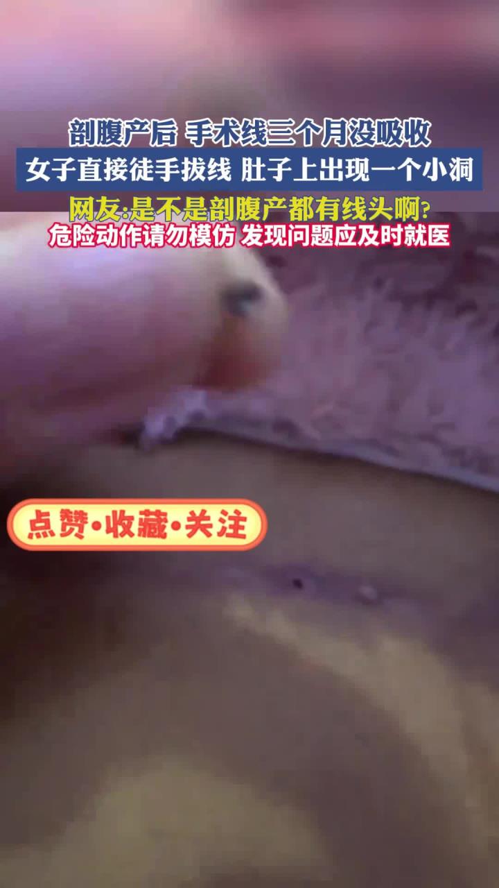 剖腹产后手术线三个月没吸收，女子直接徒手拔线