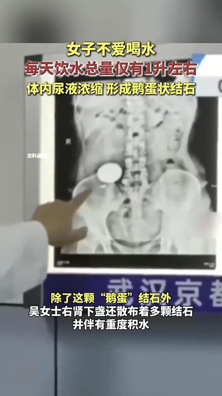 女子不爱喝水,每天饮水总量仅有1升左右,体内尿液浓缩,形成鹅