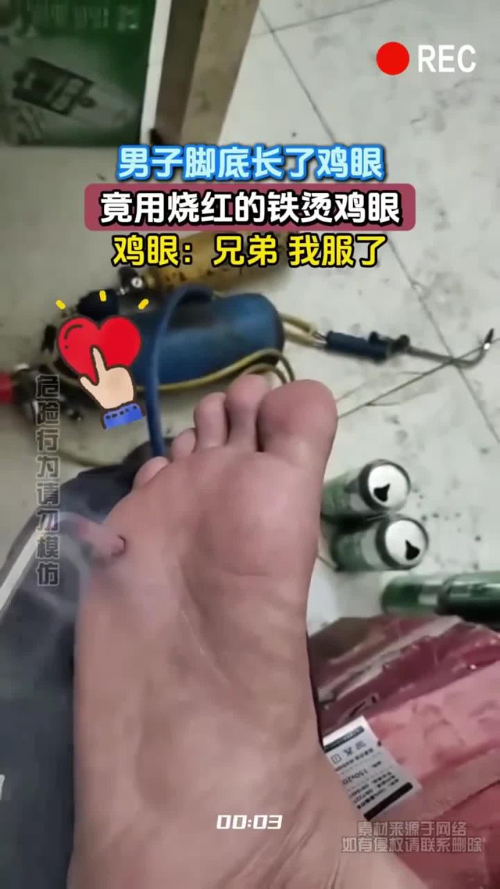 男子脚底长了鸡眼,竟用烧红的铁烫鸡眼,鸡眼:兄弟 我服了