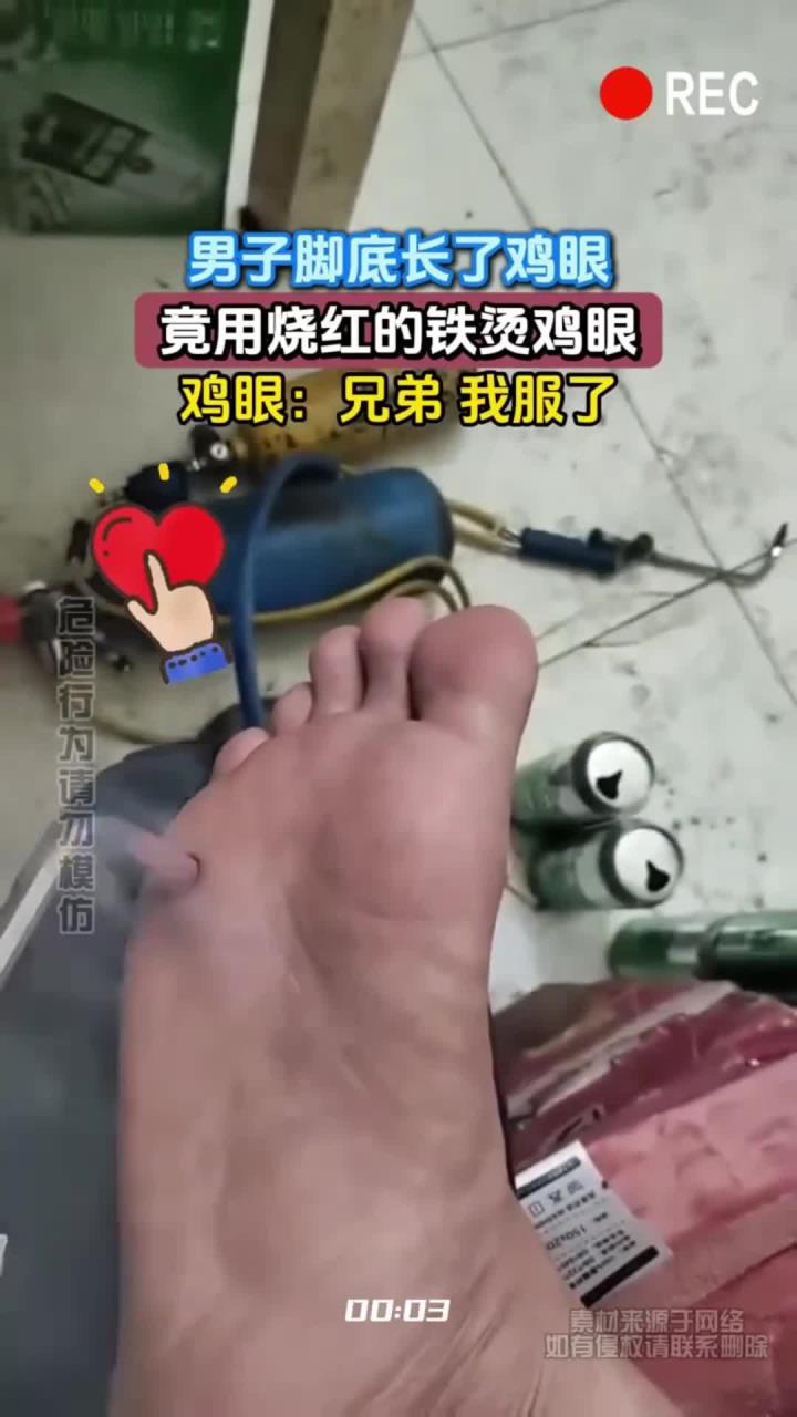 男子脚底长了鸡眼,竟用烧红的铁烫鸡眼,鸡眼:兄弟 我服了