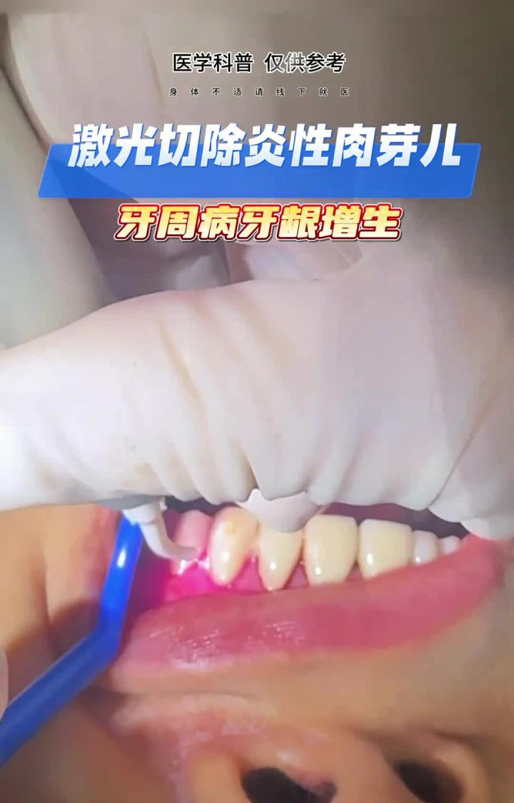 牙周病牙龈增生,用激光切除炎性肉芽组织