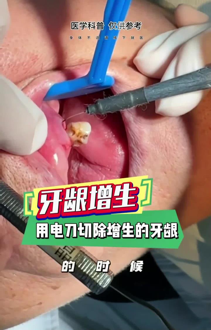 用电刀切除增生的切龈