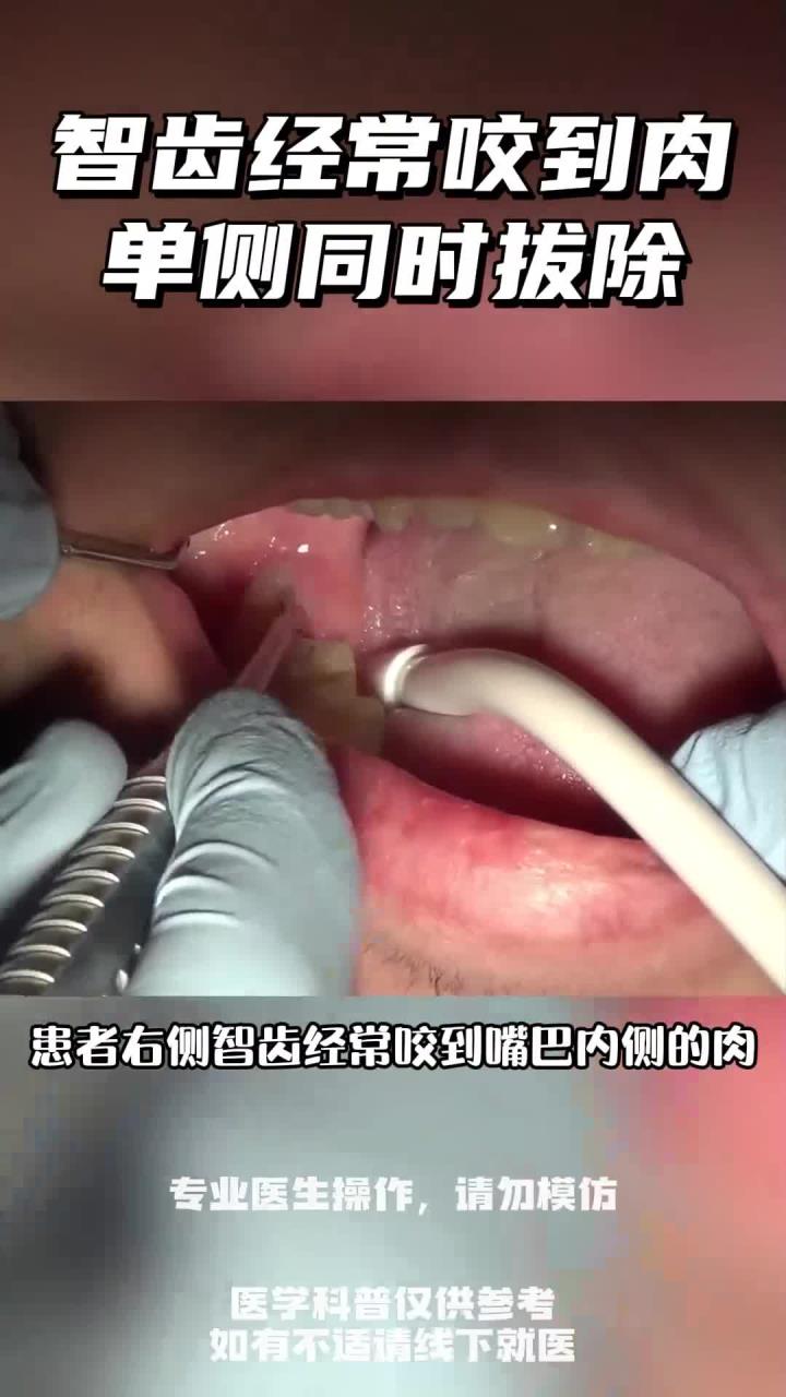 智齿经常咬到嘴巴内侧的肉?可以考虑拔掉智齿了!