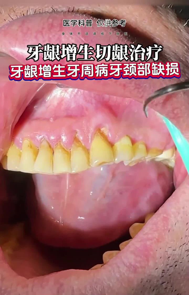 牙周病牙龈增生激光切龈治疗