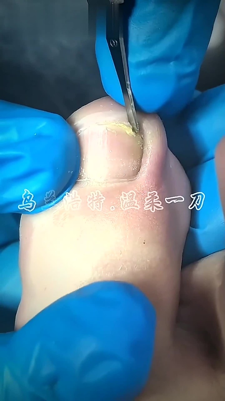 修脚视频,指甲扎肉里,自己抠的