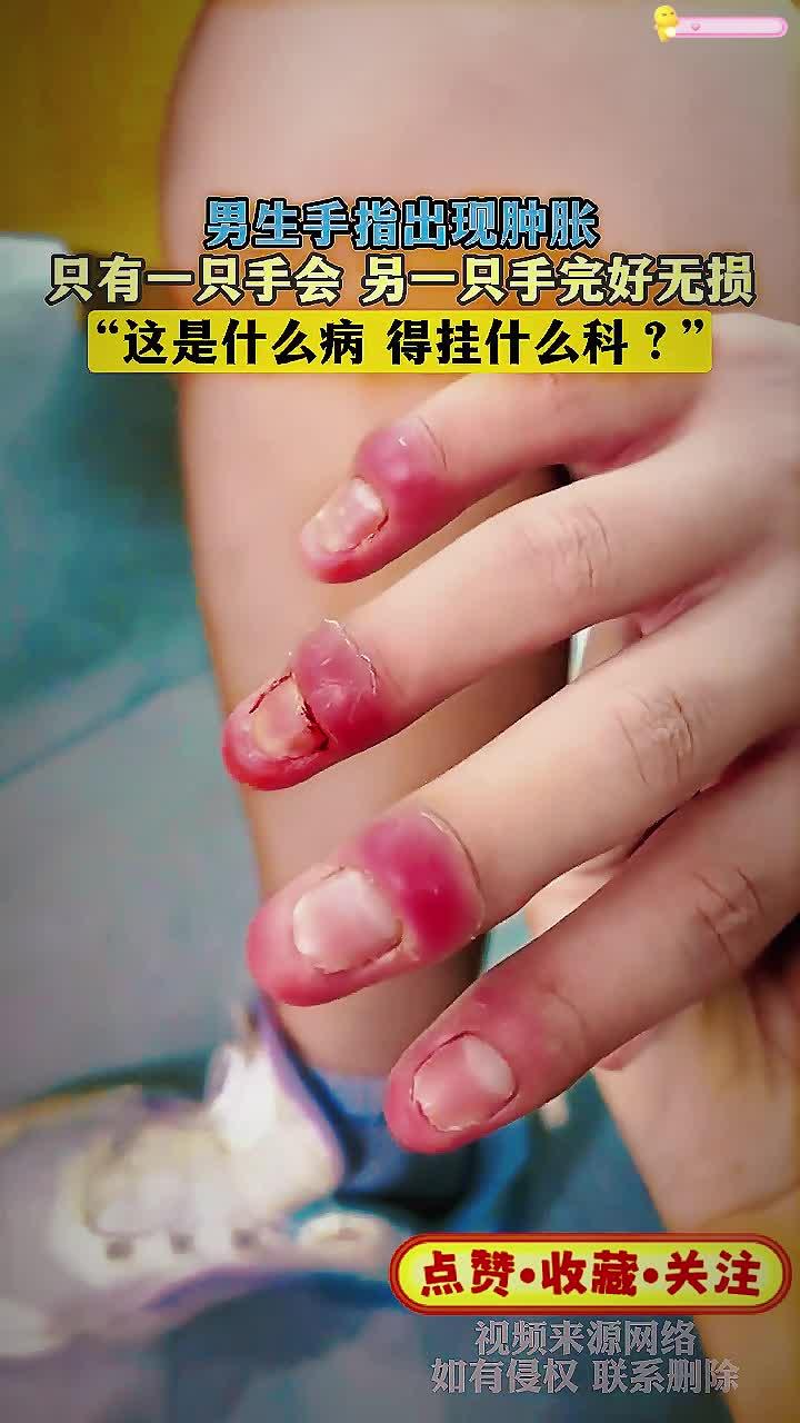 男生手指出现肿胀,只有一只手会 另一只手完好无损