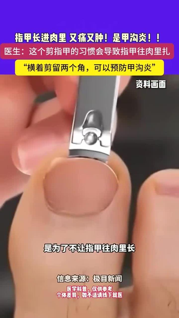 指甲长进肉里 又痛又肿!是甲沟炎!