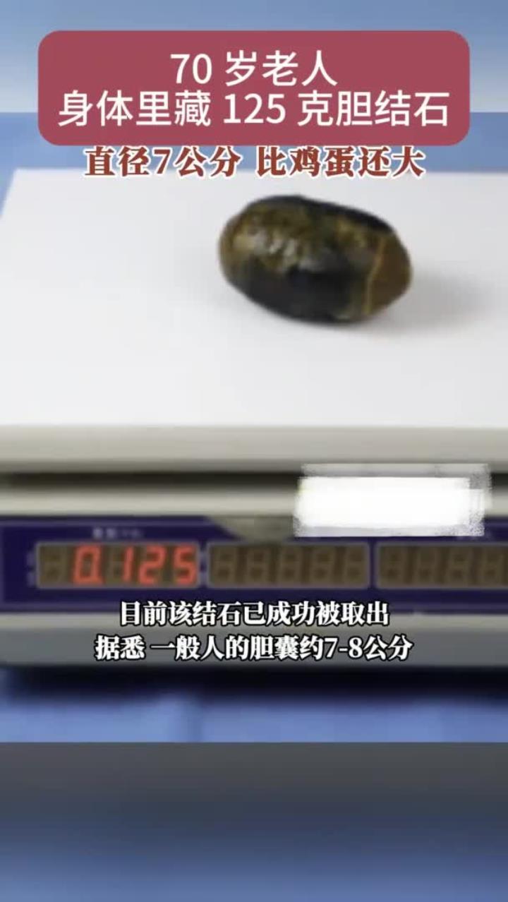 70岁老人体内藏125克胆结石,直径7公分,比鸡蛋还大