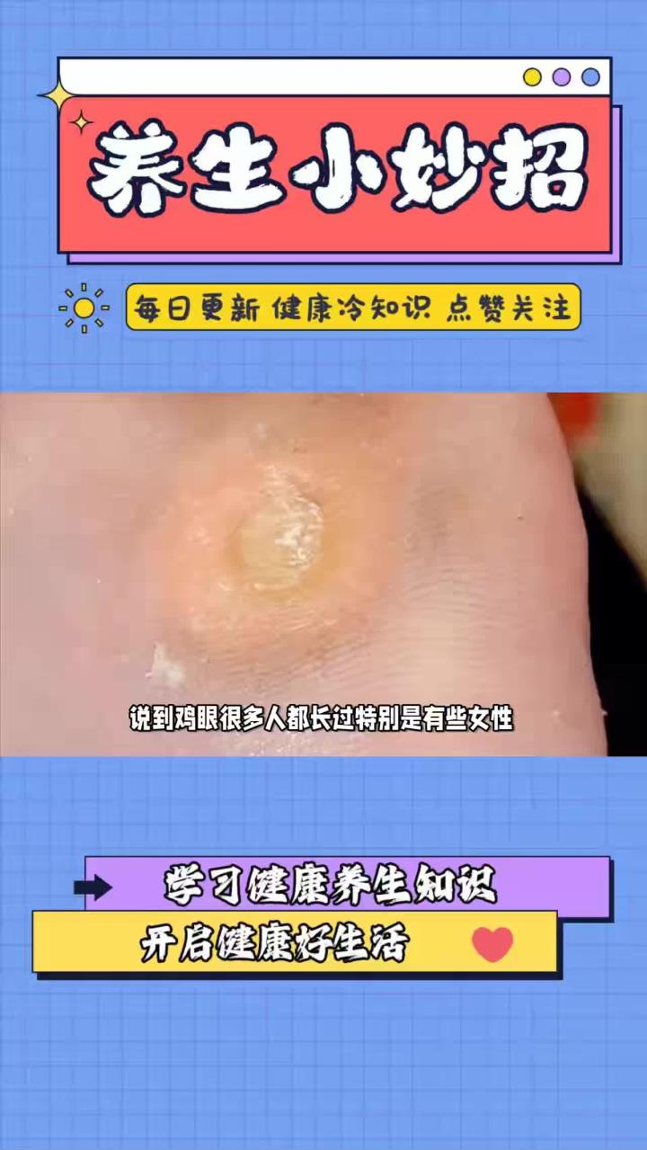 为什么脚上会长鸡眼，鸡眼会传染吗？