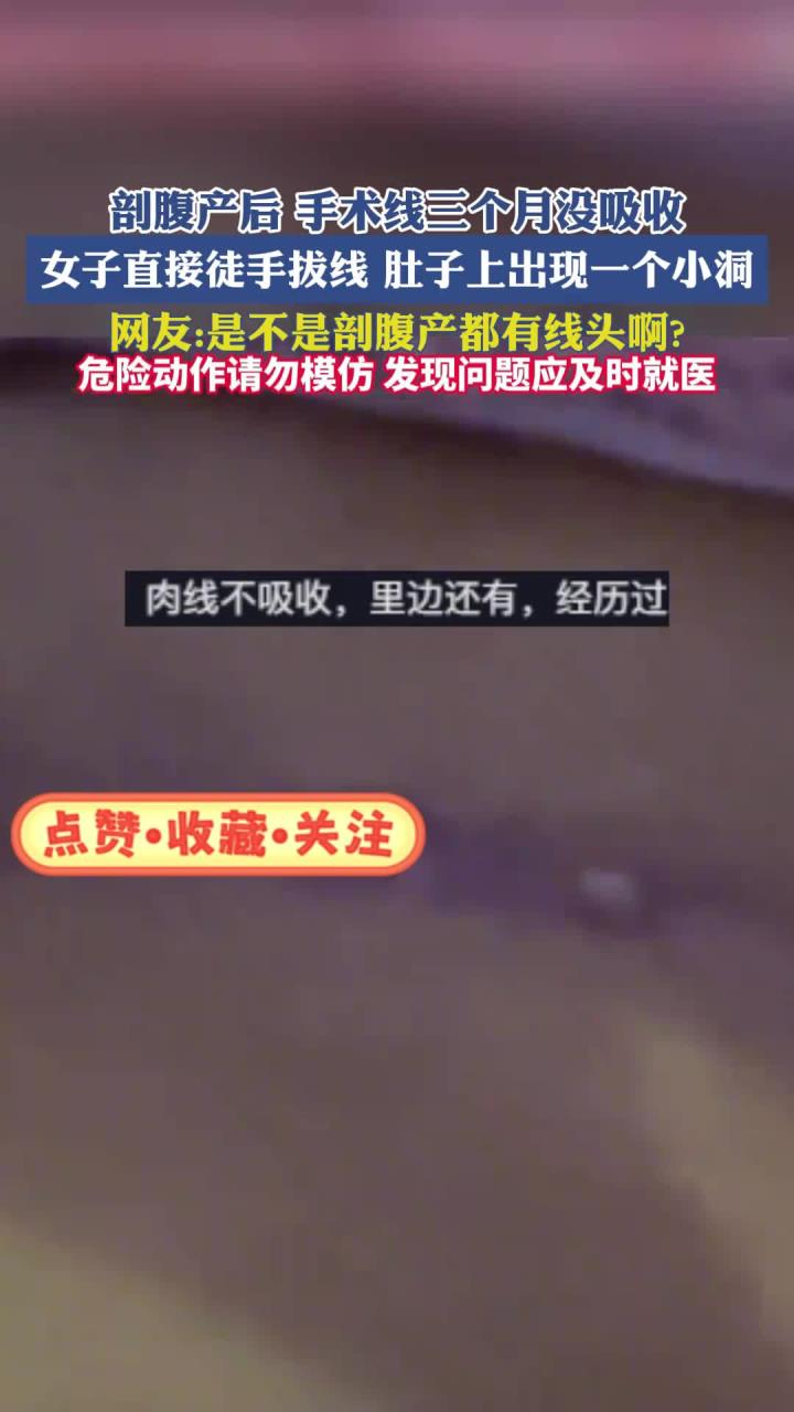 剖腹产后手术线三个月没吸收，女子直接徒手拔线
