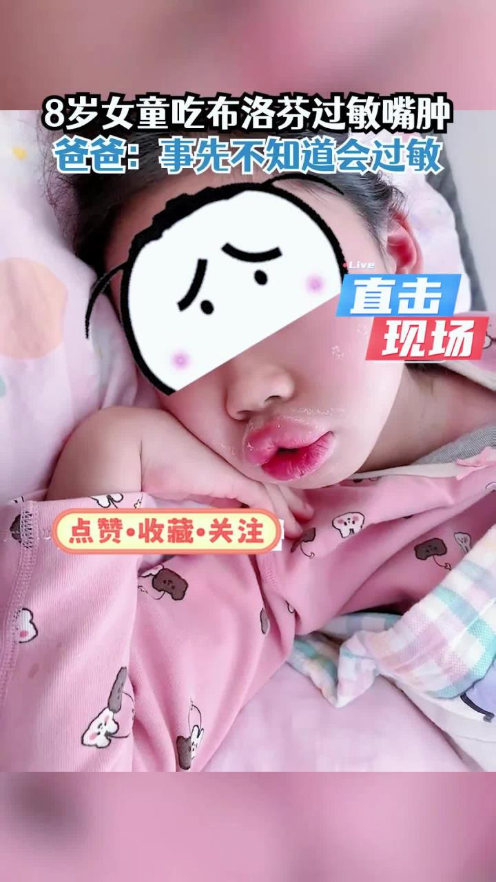 女孩吃布洛芬过敏嘴肿成可达鸭，爸爸：不知道会过敏