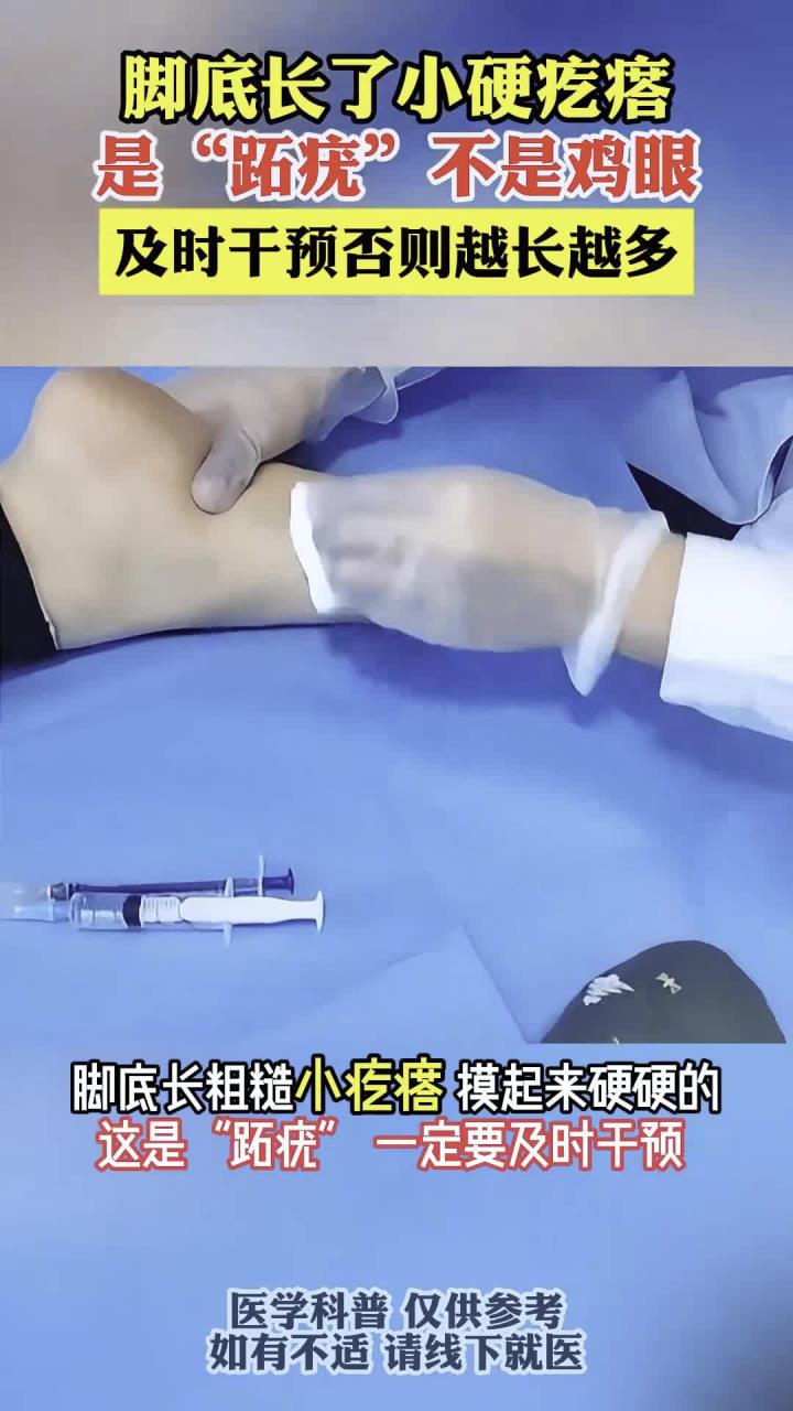 是跖疣不是鸡眼，及时干预否则越长越多！