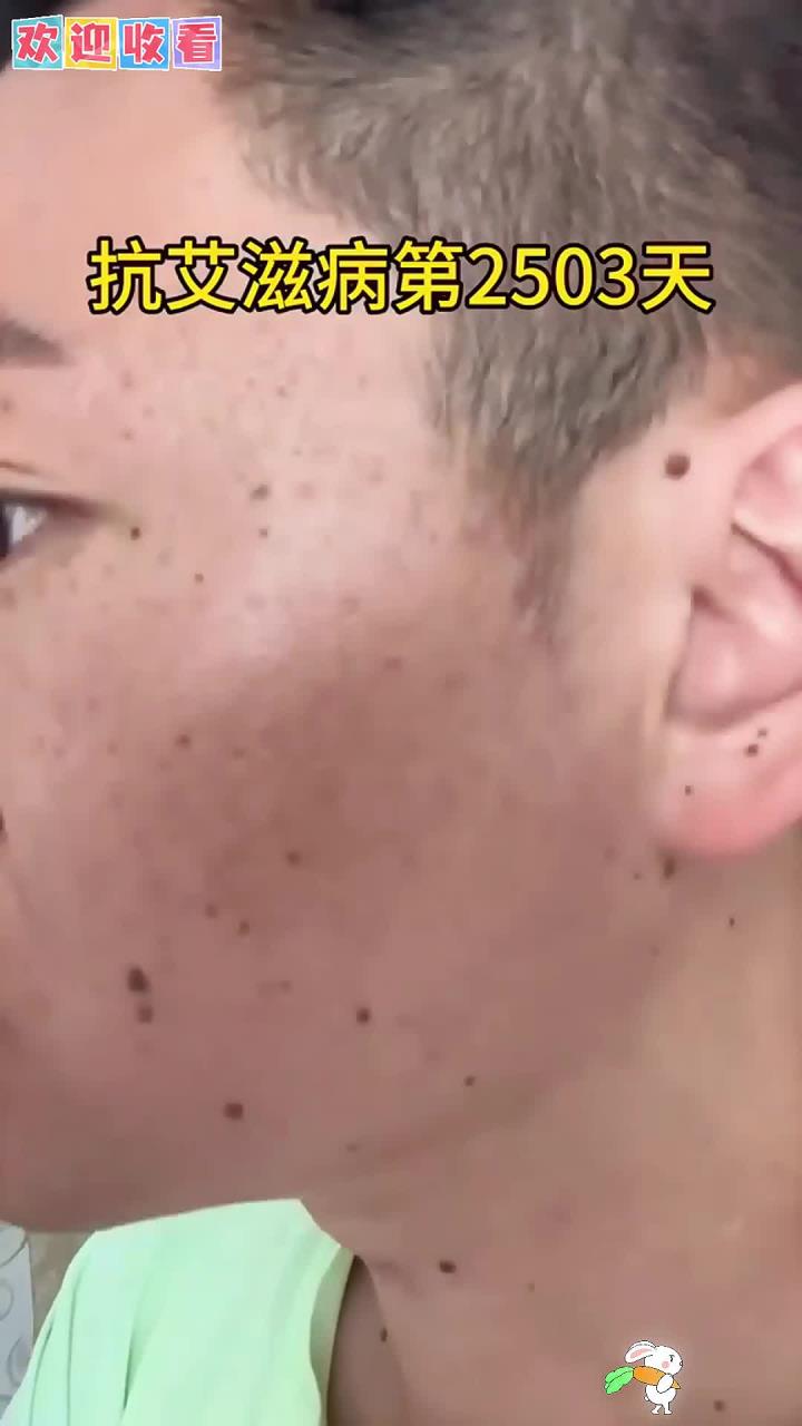 七年抗艾，脸部症状加重为卡波西肉瘤