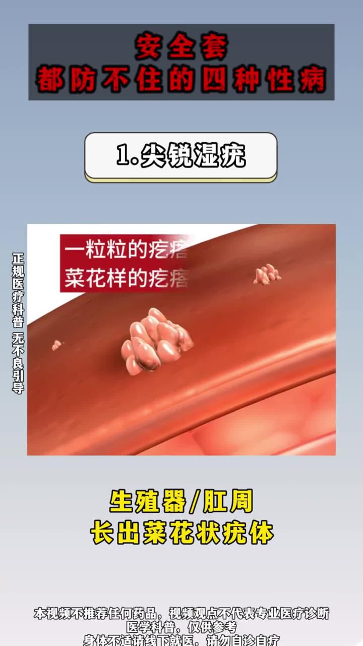 安全套都防不住的四种传染病!