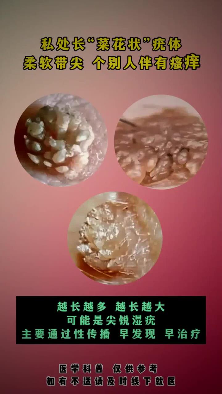 私处长菜花状疣体怎么办？