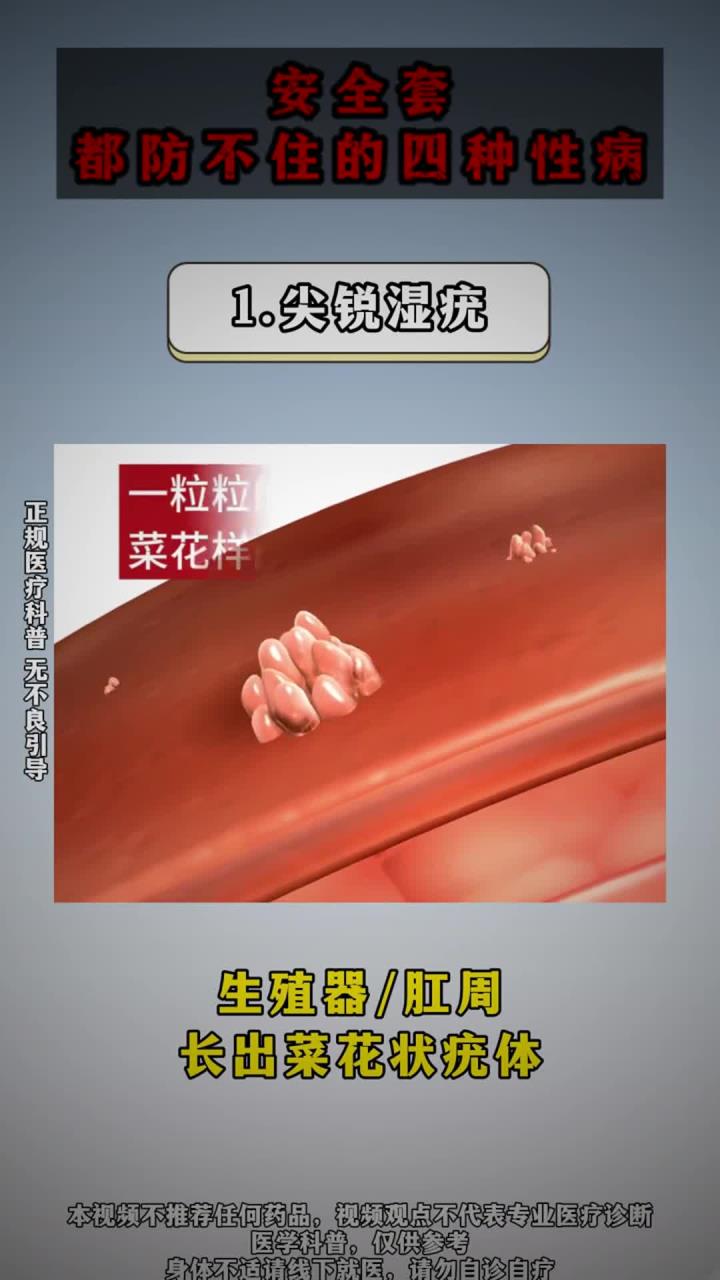 安全套都防不住的四种传染病!