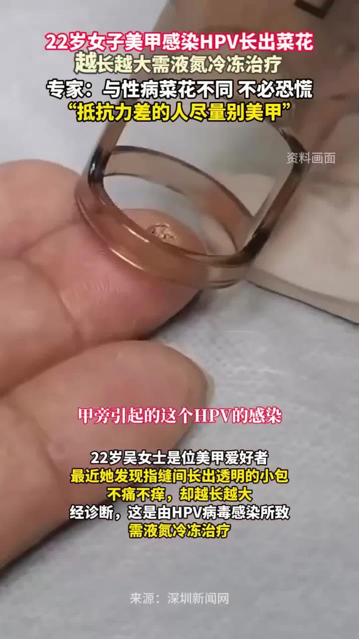 22岁女子美甲,感染HPV长出菜花