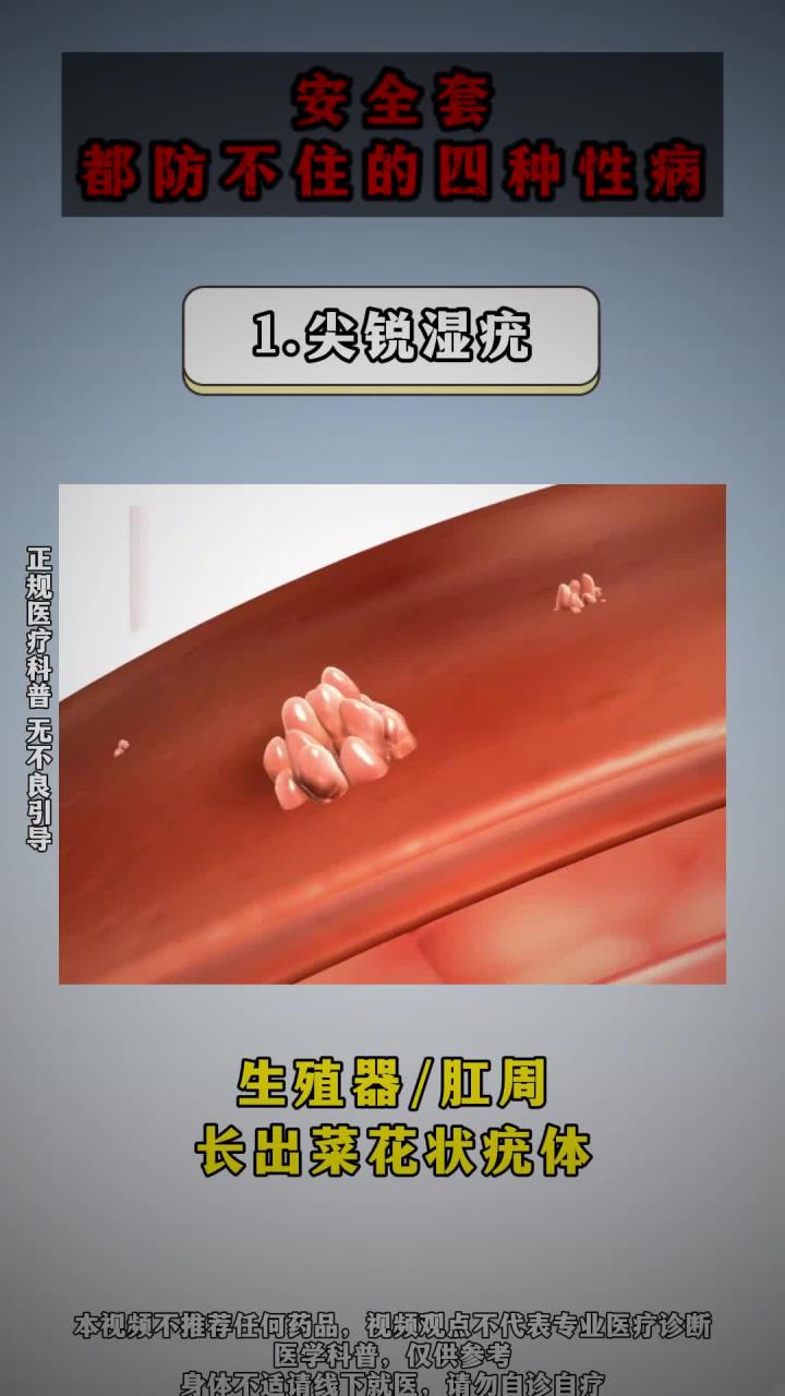 安全套都防不住的四种传染病!