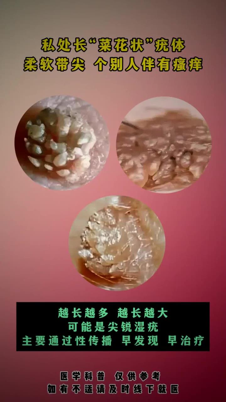 私处长菜花状疣体怎么办?