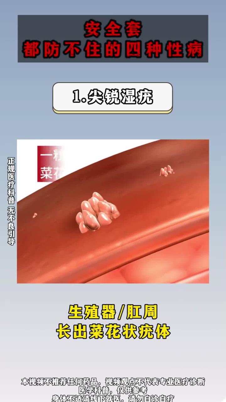 安全套都防不住的四种传染病!