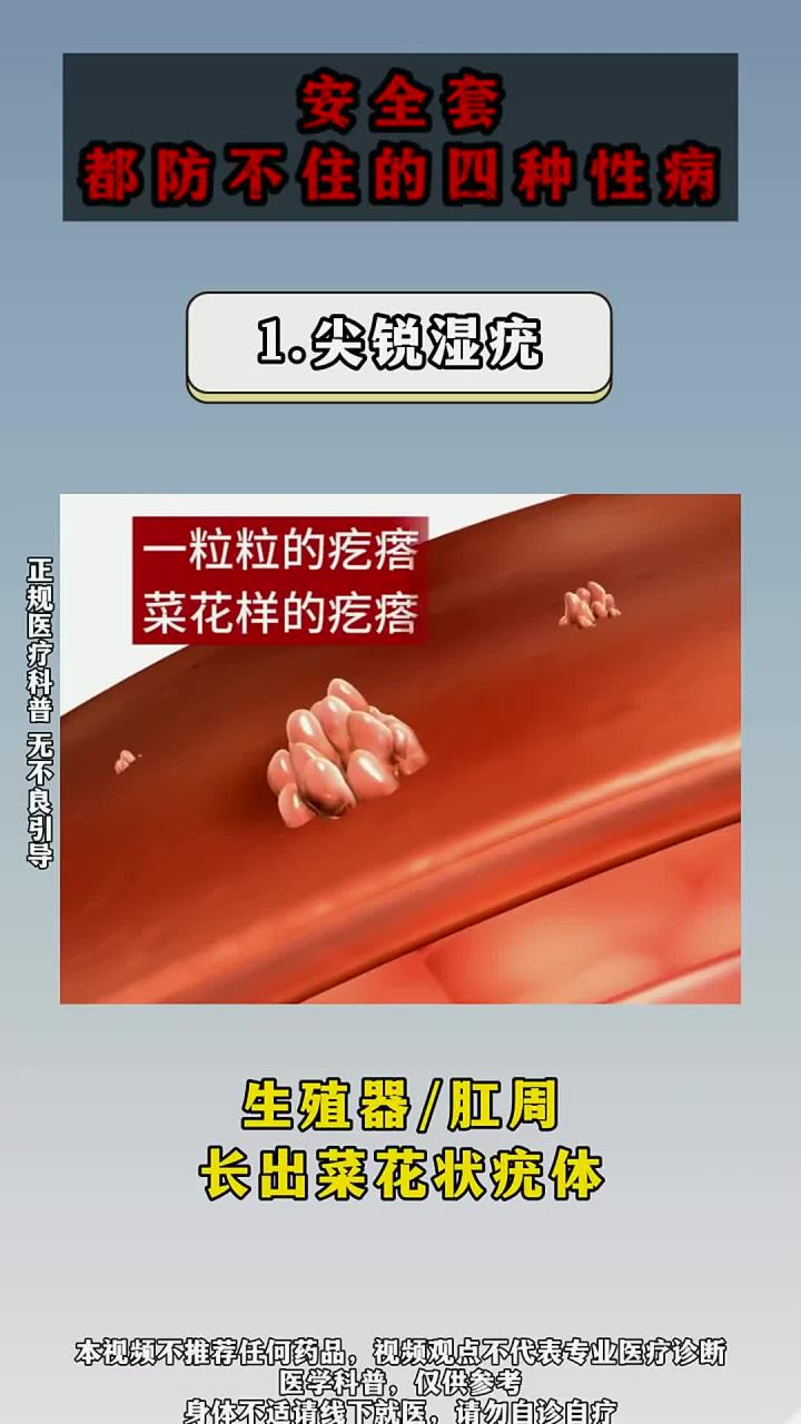 安全套都防不住的四种传染病!