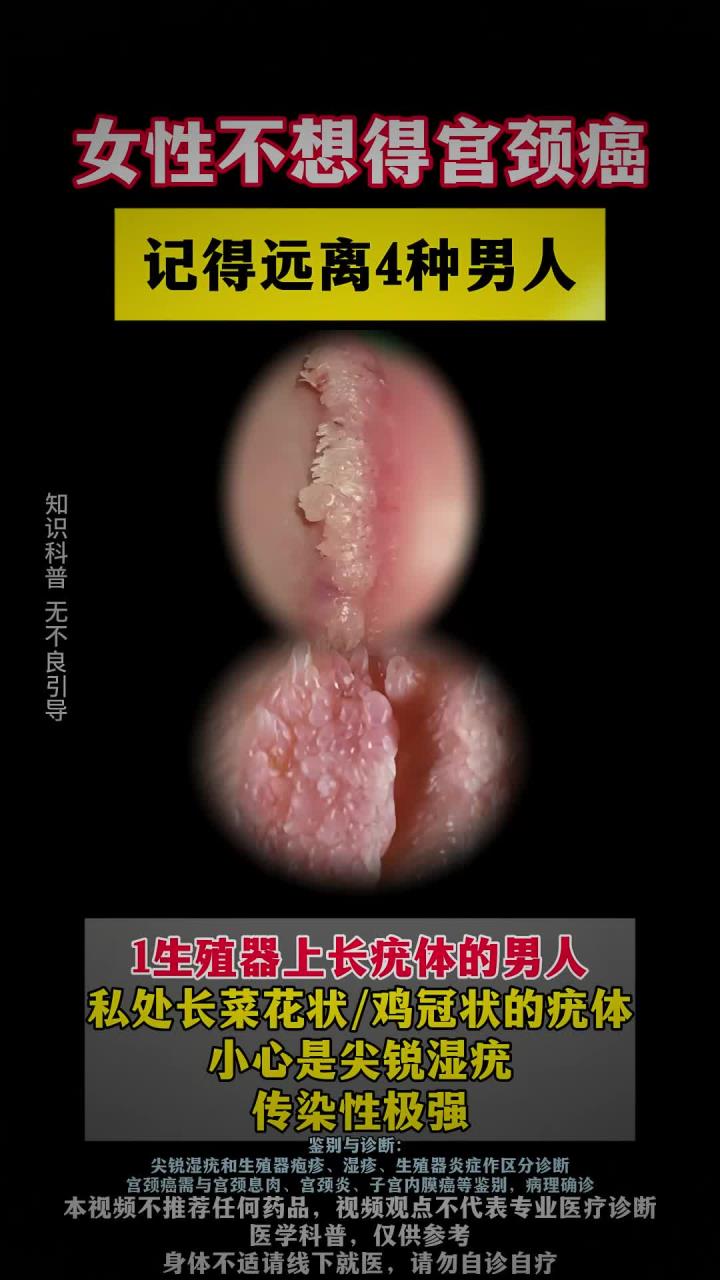 女性不想得宫颈癌 记得远离四种男人