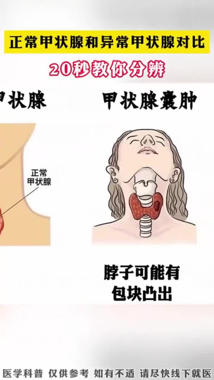 正常甲状腺和异常甲状腺对比 希望大家都是正常的