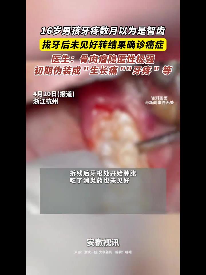16岁男孩牙疼数月以为是智齿 拔牙后未见好转结果确诊癌症 医生:骨肉瘤隐匿性极强 初