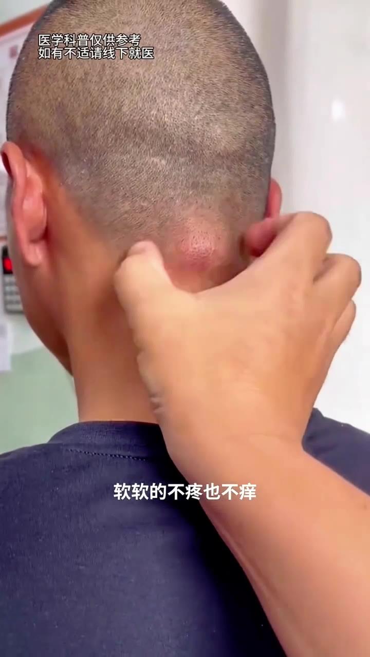 最近摸到后脑勺鼓了一个包,软软的不疼不痒,需要就医检查吗