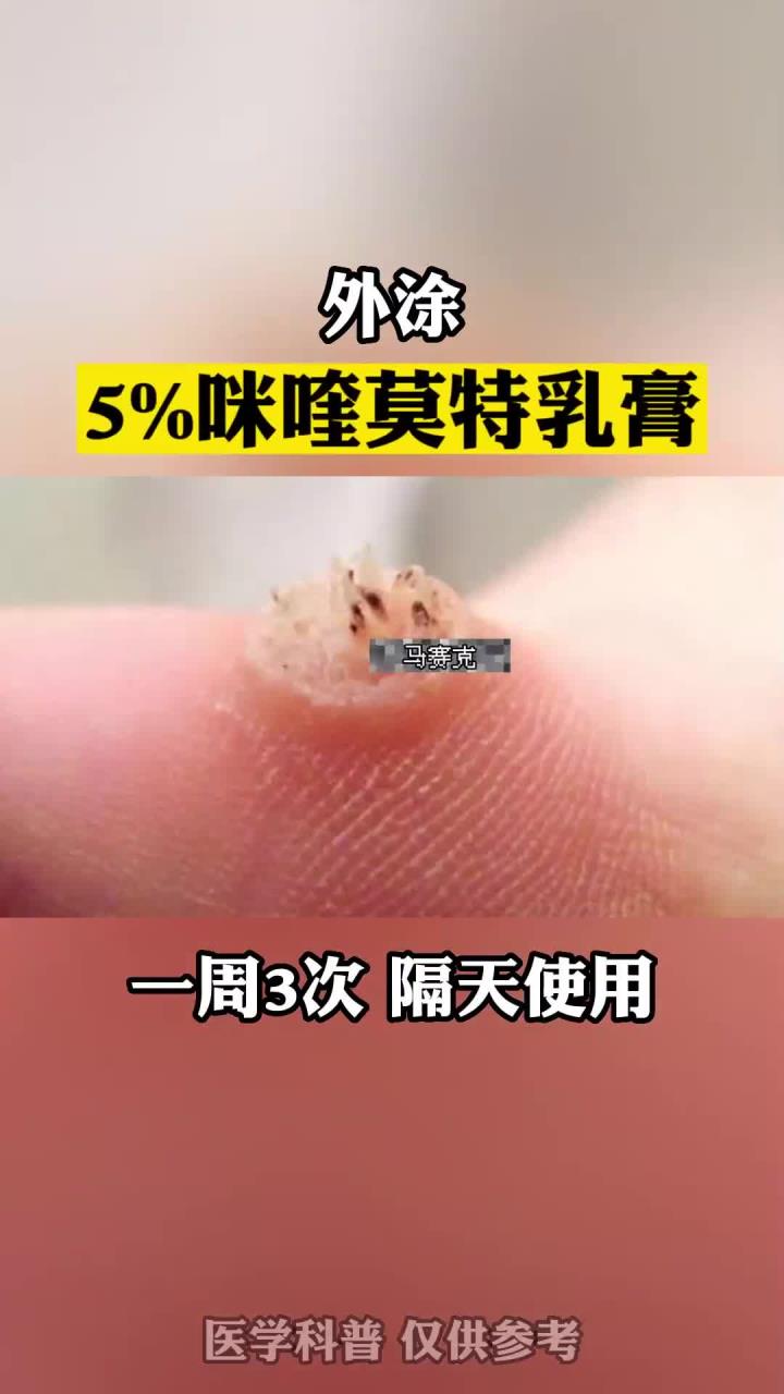 脚底板长小疙瘩,里面有很多小黑点,可别当鸡眼治!这是跖疣