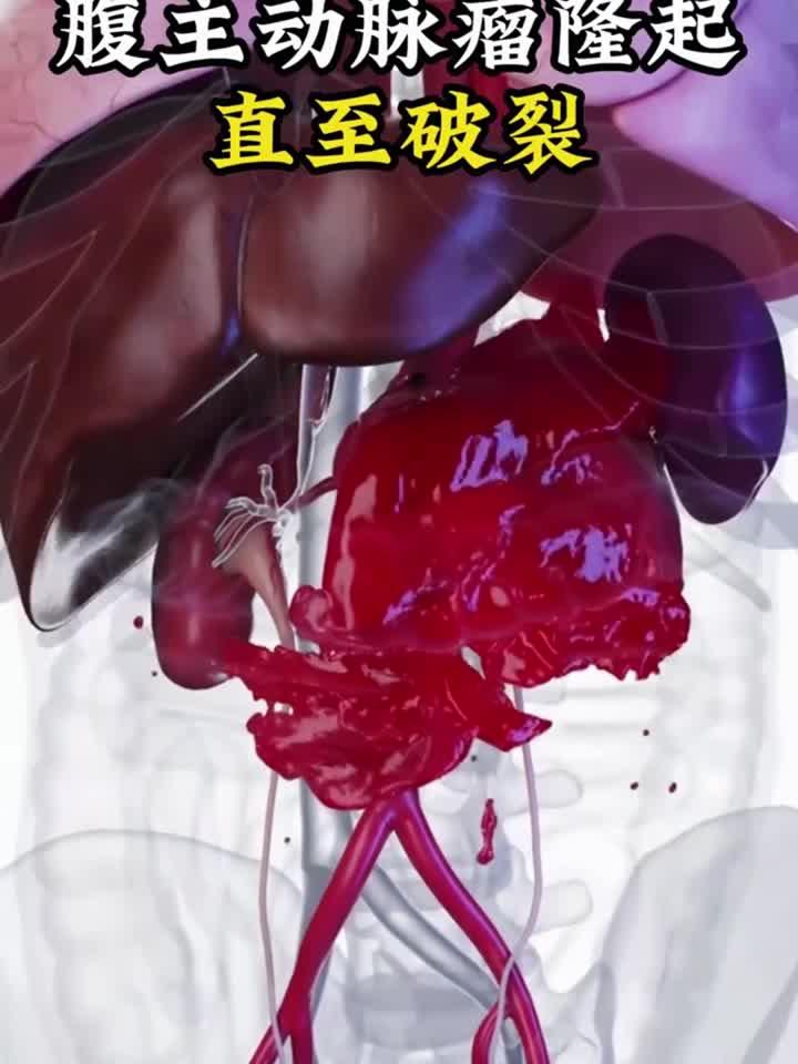 腹主动脉瘤破裂全程：从隆起瞬间到血管崩溃
