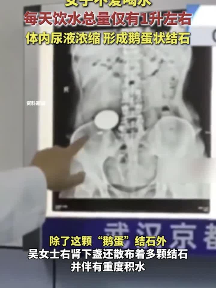 女子不爱喝水,每天饮水总量仅有1升左右,体内尿液浓缩,形成鹅
