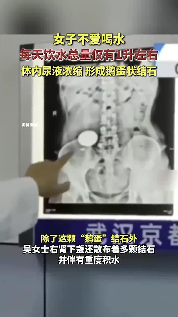 女子不爱喝水,每天饮水总量仅有1升左右,体内尿液浓缩,形成鹅