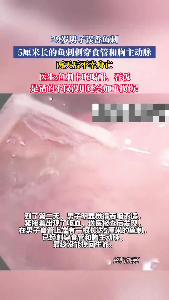 29岁男子误香鱼刺，5厘米长的鱼刺刺穿食管和胸主动脉