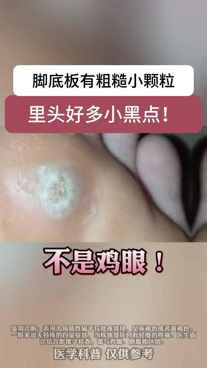 脚底板长小疙瘩,里面有很多小黑点,可别当鸡眼治!这是跖疣