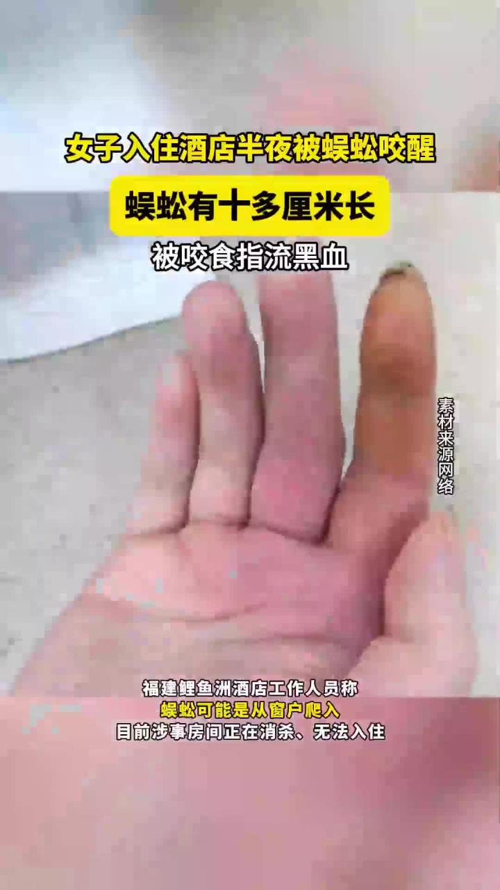 女子入住酒店半夜被蜈蚣咬醒