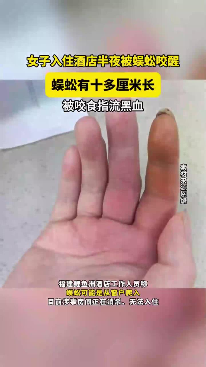 女子入住酒店半夜被蜈蚣咬醒