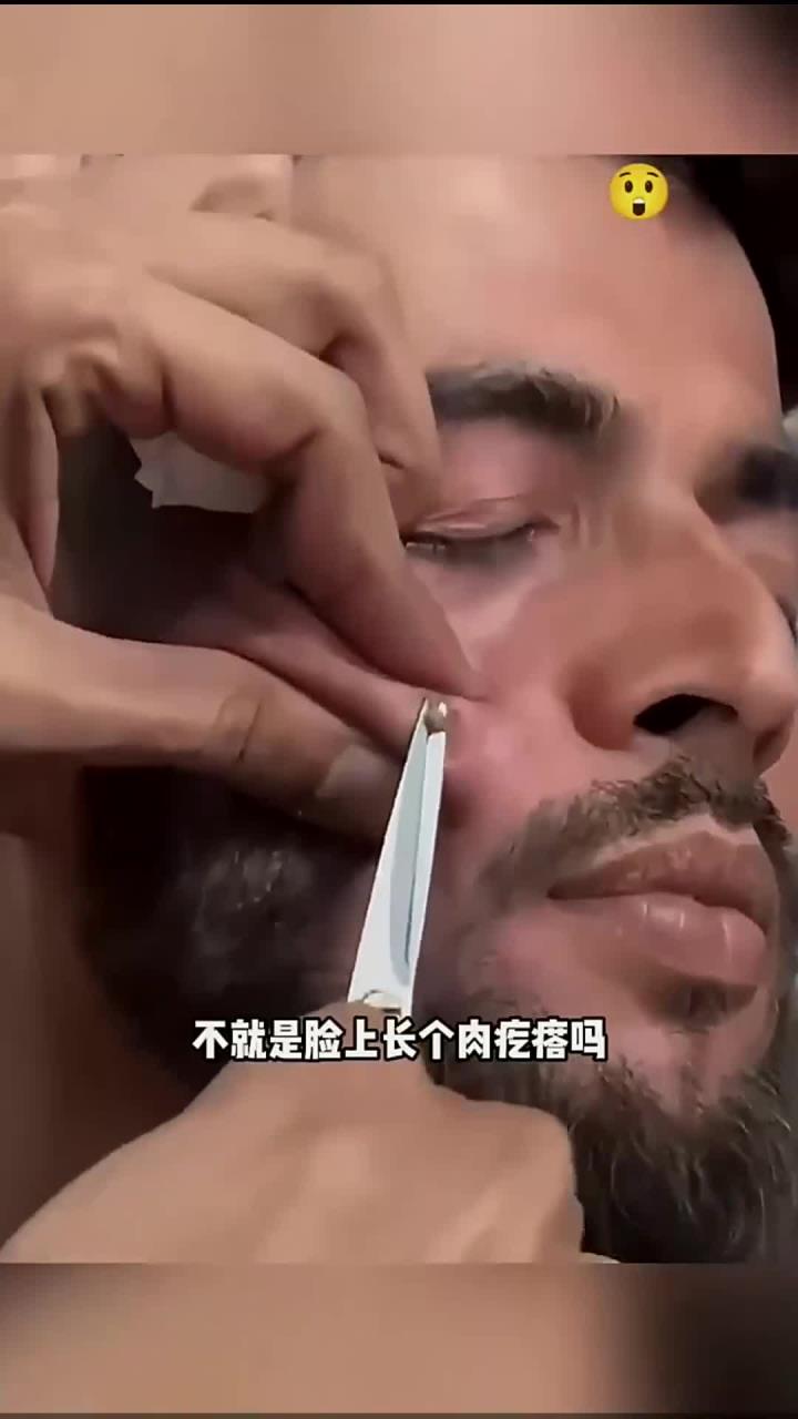 用剪刀剪肉疙瘩,看着都疼