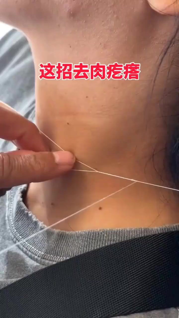 小伙这招去肉疙瘩
