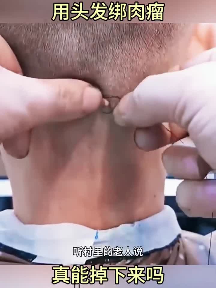 用头发绑肉瘤，真能掉下来吗