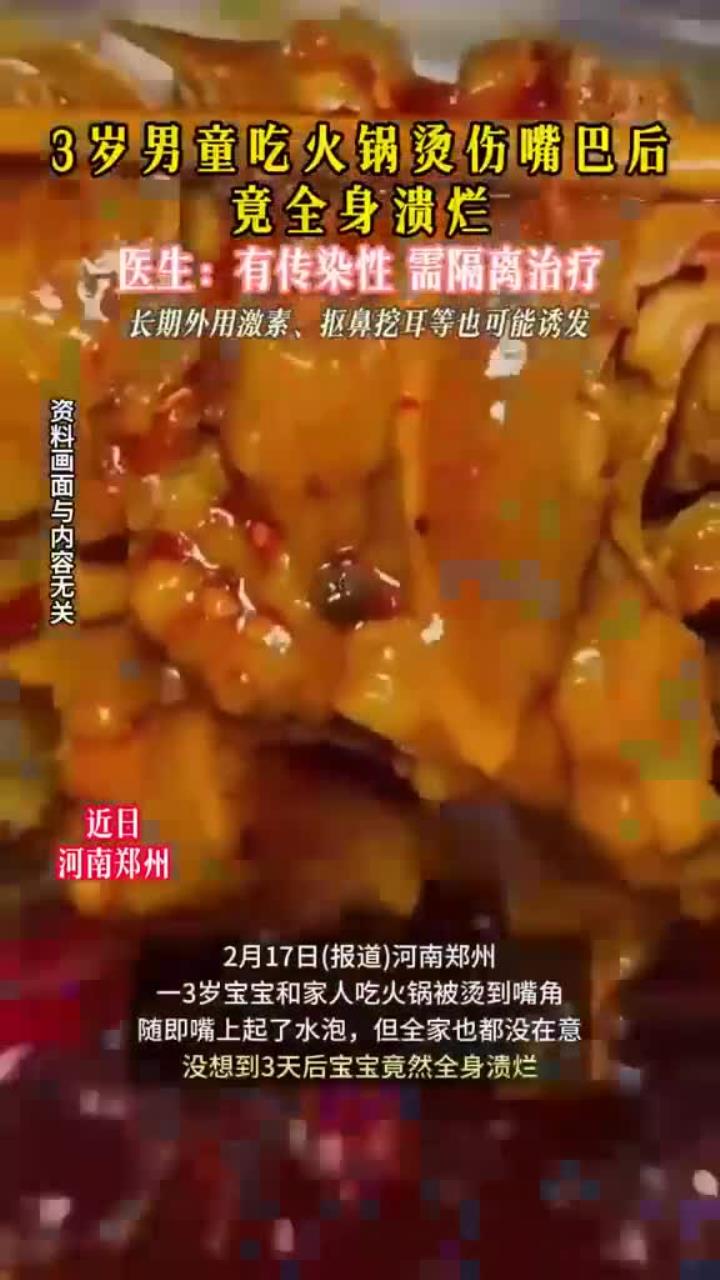 健康指南:烫伤急救护宝宝口腔健康