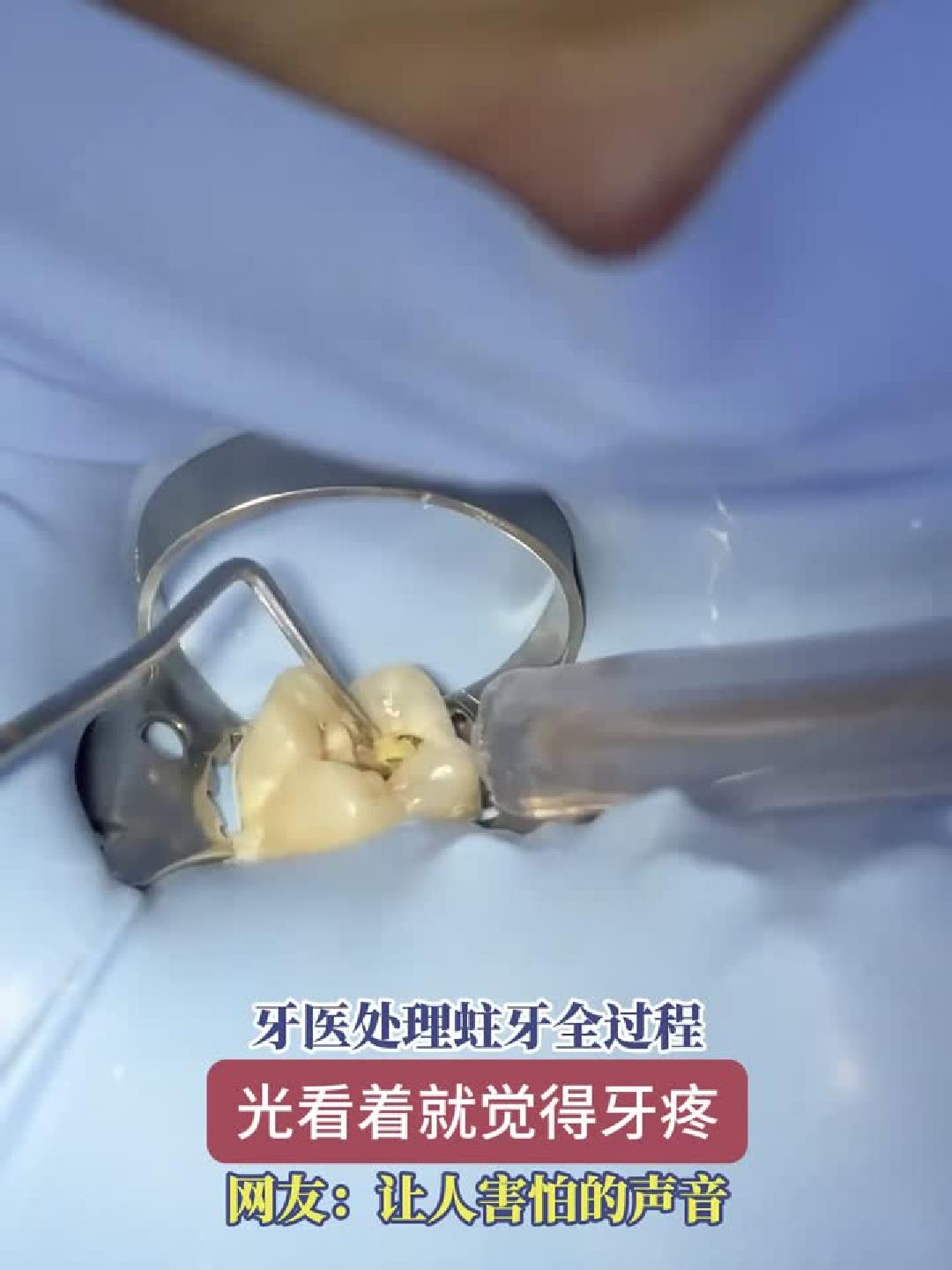 牙医处理蛀牙全过程,光看视频我牙都酸了!