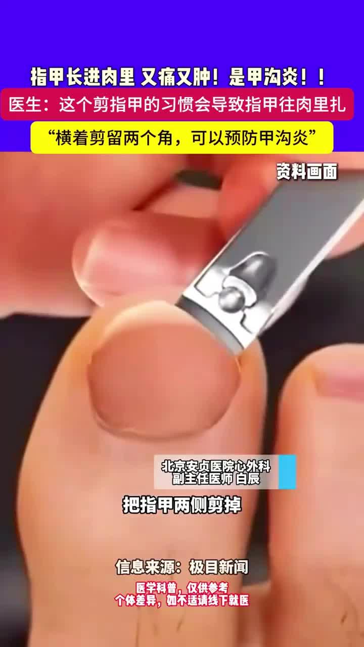 指甲长进肉里 又痛又肿！是甲沟炎！