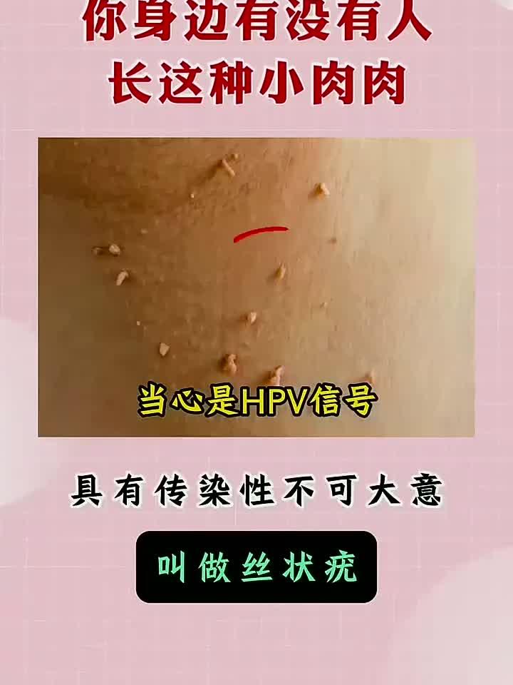 你不知道的健康小知识：身边人出现“小肉球”具有传染性 不可大