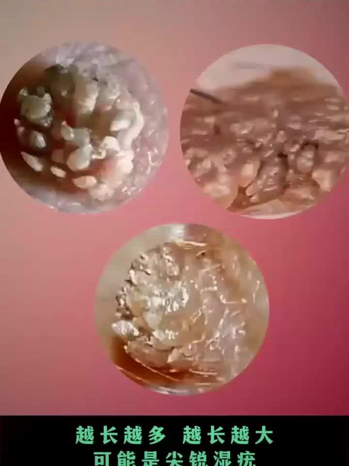 健康:私处长菜花状疣体怎么办?这些要知道!