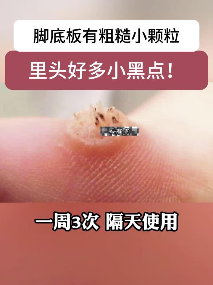 脚底板长小疙瘩,里面有很多小黑点,可别当鸡眼治!这是跖疣