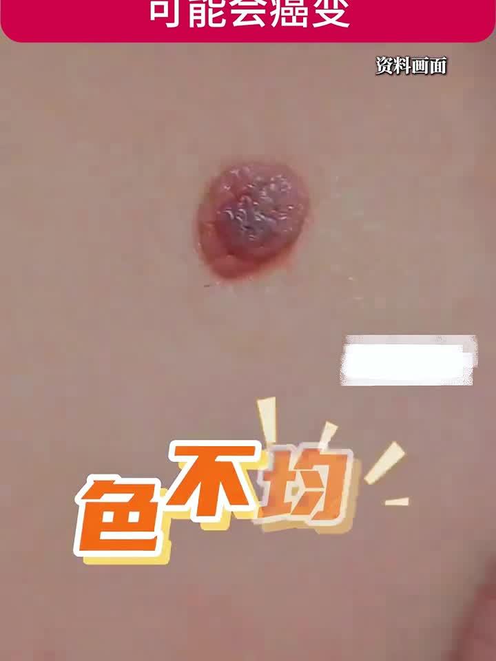 这样的痣要当心!急诊外科医生教你辨别会癌变的痣