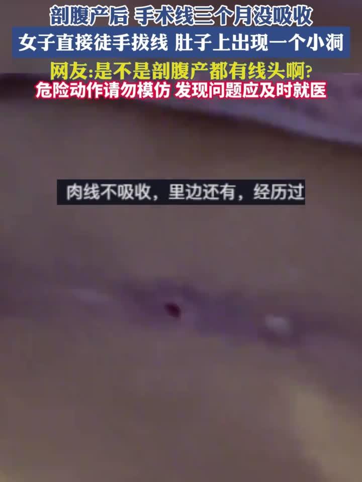 剖腹产后手术线三个月没吸收,女子直接徒手拔线
