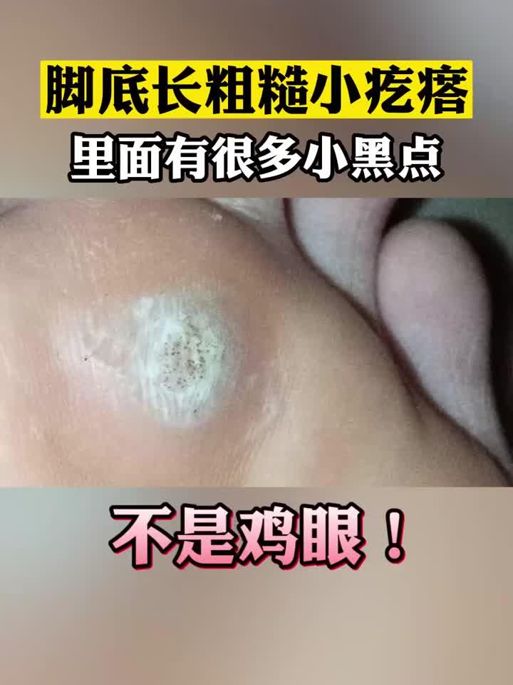 脚底疙瘩别乱治!看清小黑点,这不是鸡眼是跖疣
