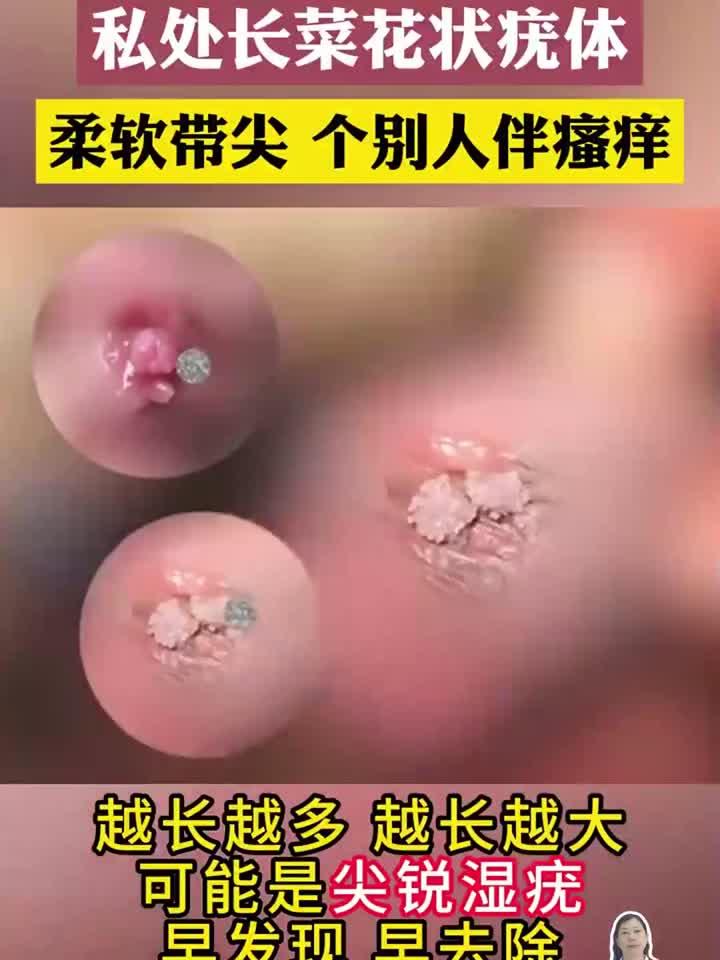 私处菜花样赘生物警示录:症状识别与应对指南